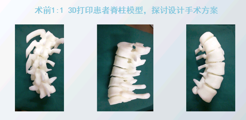 上海數(shù)造攜手安徽省二院骨三科專(zhuān)家章玉冰主任 開(kāi)展3D打印醫(yī)療骨科應(yīng)用在線(xiàn)講堂